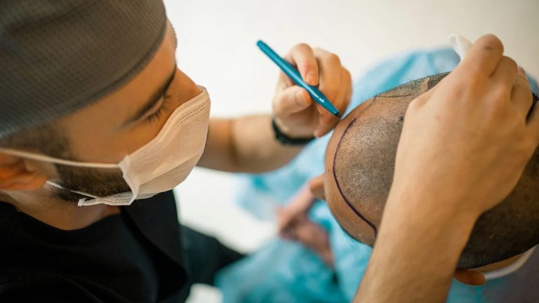 Start Your Journey Today with Hair Transplant Birmingham Experts